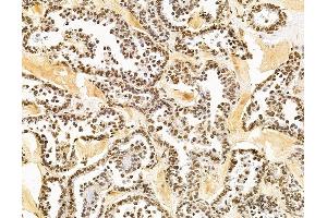 ABIN7095883 and ABIN7099945 at 1/100 staining human ovarian cancer by IHC-P. (PHRF1 Antikörper)
