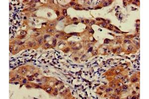 Immunohistochemistry of paraffin-embedded human lung cancer using ABIN7165899 at dilution of 1:100 (OS9 Antikörper  (AA 232-413))