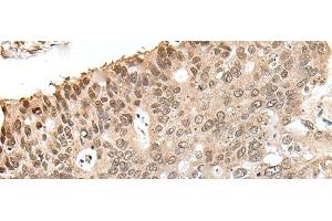 Immunohistochemistry of paraffin-embedded Human colorectal cancer tissue using ZNF410 Polyclonal Antibody at dilution of 1:40(x200) (ZNF410 Antikörper)