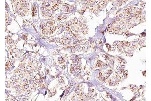 ABIN6275431 at 1/100 staining Human breast cancer tissue by IHC-P. (PDHA1 Antikörper  (C-Term))