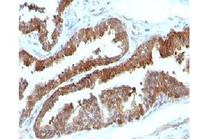 Formalin-fixed, paraffin-embedded human prostate carcinoma stained with HSP27 antibody (HSPB1/774) (HSP27 Antikörper)