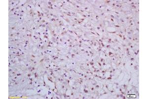 Formalin-fixed and paraffin embedded human gastric carcinoma labeled with Rabbit Anti APC70/CRSP70 Polyclonal Antibody, Unconjugated (ABIN1387561) at 1:200 followed by conjugation to the secondary antibody and DAB staining (CRSP Complex (AA 30-65) Antikörper)