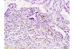 Formalin-fixed and paraffin embedded human breast carcinoma tissue labeled with Anti-Cathepsin H Polyclonal Antibody, Unconjugated (ABIN732758) at 1:200 followed by conjugation to the secondary antibody, (SP-0023), and DAB staining (Cathepsin H Antikörper  (AA 71-170))