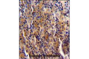 SYNE3 antibody immunohistochemistry analysis in formalin fixed and paraffin embedded human hodgkin lymphoma followed by peroxidase conjugation of the secondary antibody and DAB staining. (Nesprin3 Antikörper  (C-Term))