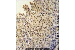 DI3L1 Antibody (N-term) (ABIN651802 and ABIN2840405) immunohistochemistry analysis in formalin fixed and paraffin embedded human cervix carcinoma followed by peroxidase conjugation of the secondary antibody and DAB staining. (DIS3L Antikörper  (N-Term))