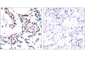 Immunohistochemistry analysis of paraffin-embedded human breast carcinoma tissue, using c-Jun (Ab-170) Antibody. (C-JUN Antikörper  (AA 137-186))