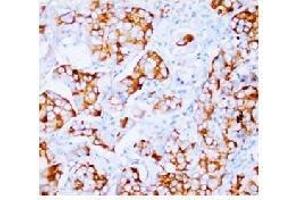 Immunohistochemical analysis of Paraffin Embeedded Mammary cancer sections using FGF2 antibody. (FGF2 Antikörper  (N-Term))