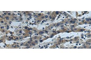Immunohistochemistry of paraffin-embedded Human liver cancer tissue using CUL5 Polyclonal Antibody at dilution of 1:55(x200) (Cullin 5 Antikörper)