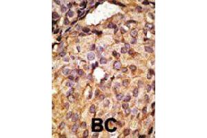 Formalin-fixed and paraffin-embedded human cancer tissue reacted with Tlr6 polyclonal antibody  , which was peroxidase-conjugated to the secondary antibody, followed by AEC staining. (TLR6 Antikörper  (C-Term))