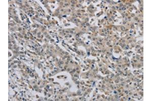 The image on the left is immunohistochemistry of paraffin-embedded Human liver cancer tissue using ABIN7189784(ALX4 Antibody) at dilution 1/20, on the right is treated with synthetic peptide. (ALX4 Antikörper)
