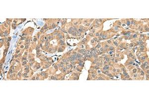 Immunohistochemistry of paraffin-embedded Human thyroid cancer tissue using FAM110B Polyclonal Antibody at dilution of 1:40(x200)