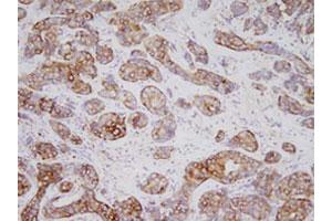 Immunohistochemistry of human breast carcinoma tissues were incubated with TPD52L1 monoclonal antibody , clone d1C5 (1 : 200)  at room temperature. (TPD52L1 Antikörper  (AA 1-131))