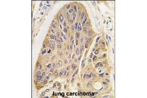 Formalin-fixed and paraffin-embedded human lung carcinoma tissue reacted with hMAP2-Q425 antibody, which was peroxidase-conjugated to the secondary antibody, followed by DAB staining. (MAP2 Antikörper  (C-Term))
