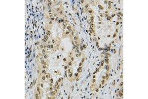 Immunohistochemical analysis of JUNB staining in human lung cancer formalin fixed paraffin embedded tissue section.