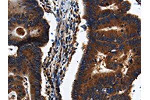 The image on the left is immunohistochemistry of paraffin-embedded Human colon cancer tissue using ABIN7191225(KLHL8 Antibody) at dilution 1/20, on the right is treated with synthetic peptide. (KLHL8 Antikörper)
