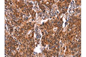 The image on the left is immunohistochemistry of paraffin-embedded Human gastric cancer tissue using ABIN7190641(FEM1A Antibody) at dilution 1/20, on the right is treated with synthetic peptide. (FEM1A Antikörper)
