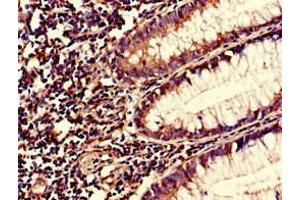 Immunohistochemistry of paraffin-embedded human colon cancer using ABIN7166034 at dilution of 1:100 (S1A1 (AA 2-97) Antikörper)