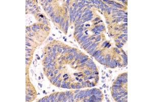 Immunohistochemistry of paraffin-embedded human colon carcinoma using HMGCL antibody. (HMGCL Antikörper  (AA 1-325))