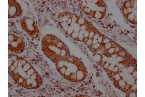 IHC image of ABIN7127629 diluted at 1:100 and staining in paraffin-embedded human colon cancer performed on a Leica BondTM system. (Rekombinanter SLC16A1 Antikörper)