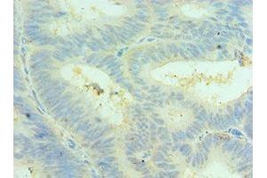 Immunohistochemistry of paraffin-embedded human colon cancer using ABIN7147590 at dilution of 1:100