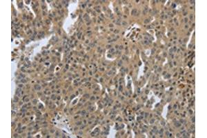 The image on the left is immunohistochemistry of paraffin-embedded Human ovarian cancer tissue using ABIN7192074(PTPRT Antibody) at dilution 1/30, on the right is treated with synthetic peptide. (PTPRT Antikörper)