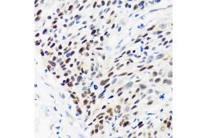 Immunohistochemistry of paraffin-embedded Human esophageal cancer using WDHD1 Rabbit pAb (ABIN7271351) at dilution of 1:100 (40x lens). (WDHD1 Antikörper  (AA 830-1129))