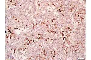 Formalin-fixed and paraffin embedded human lung carcinoma labeled with Anti-Phospho-MAPKAPK2(Thr334) Polyclonal Antibody, Unconjugated (ABIN743693) at 1:200 followed by conjugation to the secondary antibody and DAB staining (MAPKAP Kinase 2 Antikörper  (pThr334))