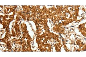 Immunohistochemistry of paraffin-embedded Human lung cancer using Otocadherin Polyclonal Antibody at dilution of 1:80 (CDH23 Antikörper)