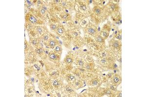 Immunohistochemistry of paraffin-embedded human liver injury using OGT antibody at dilution of 1:100 (x40 lens).