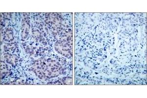 Immunohistochemistry analysis of paraffin-embedded human breast carcinoma tissue, using HDAC2 (Ab-394) Antibody. (HDAC2 Antikörper  (AA 360-409))