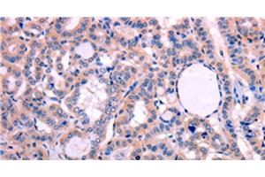 Immunohistochemistry of paraffin-embedded Human thyroid cancer tissue using LEP Polyclonal Antibody at dilution 1:30 (Leptin Antikörper)
