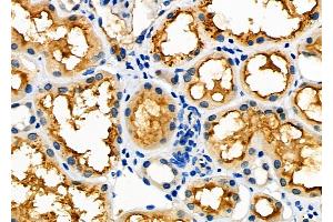 ABIN6265906 and ABIN6277616 at 1/100 staining Human kidney cancer and adjacent normal tissues by IHC-P. (UROD Antikörper  (C-Term))