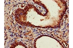 Immunohistochemistry of paraffin-embedded human prostate cancer using ABIN7150624 at dilution of 1:100 (Mre11 Antikörper  (AA 1-205))