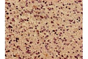 Immunocytochemistry analysis of human glioma using ABIN7171638 at dilution of 1:100 (TBC1D31 Antikörper  (AA 662-1001))