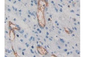 DAB staining on IHC-P; Samples: Human Glioma Tissue) (VEGFA Antikörper  (AA 28-147))