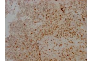 IHC image of ABIN7127357 diluted at 1:100 and staining in paraffin-embedded human cervical cancer performed on a Leica BondTM system. (Rekombinanter Aurora Kinase B Antikörper)