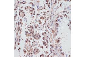 Immunohistochemistry of paraffin-embedded human lung cancer using RP/RP/RP antibody (ABIN6128653, ABIN6147083, ABIN6147084 and ABIN6214011) at dilution of 1:100 (40x lens). (RPA1 Antikörper  (AA 1-240))