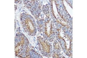 Immunohistochemistry of paraffin-embedded human colon carcinoma using  Rabbit pAb (ABIN7265359) at dilution of 1:50 (40x lens). (ABI1 Antikörper  (AA 180-230))