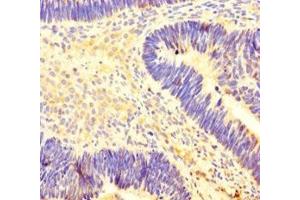 Immunohistochemistry of paraffin-embedded human ovarian cancer using ABIN7155449 at dilution of 1:100 (CARM1 Antikörper  (AA 209-379))