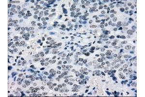 Immunohistochemical staining of paraffin-embedded Adenocarcinoma of colon tissue using anti-CRYABmouse monoclonal antibody. (CRYAB Antikörper)