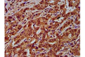 IHC image of ABIN7148830 diluted at 1:200 and staining in paraffin-embedded human liver cancer performed on a Leica BondTM system. (GARP Antikörper  (AA 131-253))