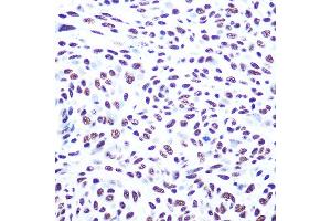 Immunohistochemistry of paraffin-embedded human esophageal cancer using DNA-PKcs Rabbit pAb (ABIN1513422, ABIN3021956 and ABIN3021957) at dilution of 1:100 (40x lens).