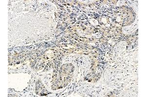 Cytokeratin 16 Mouse Monoclonal Antibody at 1/100 staining human lung cancer and adjacent non-tumor tissue by IHC-P. (KRT16 Antikörper  (C-Term))