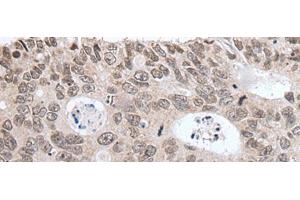 Immunohistochemistry of paraffin-embedded Human colorectal cancer tissue using HIST1H3A Polyclonal Antibody at dilution of 1:35(x200) (HIST1H3A Antikörper)