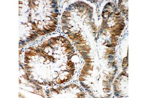 Anti-SQSTM1/p62 antibody, IHC(P) IHC(P): Human Intestinal Cancer Tissue (SQSTM1 Antikörper  (N-Term))