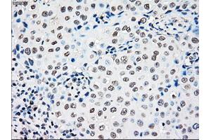 Immunohistochemical staining of paraffin-embedded Adenocarcinoma of colon tissue using anti-RAD9Amouse monoclonal antibody. (RAD9A Antikörper)