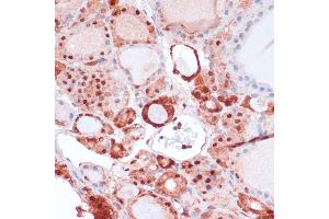 Immunohistochemistry of paraffin-embedded human thyroid cancer using S100 antibody (ABIN7270126) at dilution of 1:100 (40x lens).