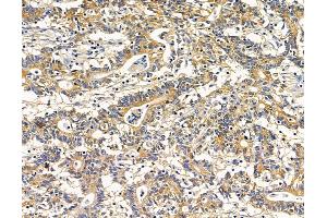 ABIN7095945 and ABIN7100007 at 1/100 staining human colorectal cancer by IHC-P. (RASGRP4 Antikörper)