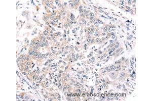 Immunohistochemistry of Human prostate cancer using ROR1 Polyclonal Antibody at dilution of 1:45 (ROR1 Antikörper)