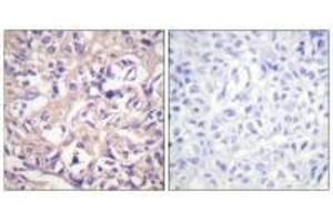 Immunohistochemistry analysis of paraffin-embedded human breast carcinoma tissue using TK (Ab-13) antibody.
